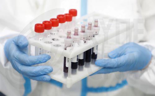 Liver disease is increasing in Europe, free liver screening in Cyprus, ELPA President  tells CNA